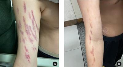 Purpura with regular shape in an adolescent: Beware of dermatitis artefacta